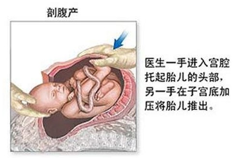 剖腹產(chǎn)